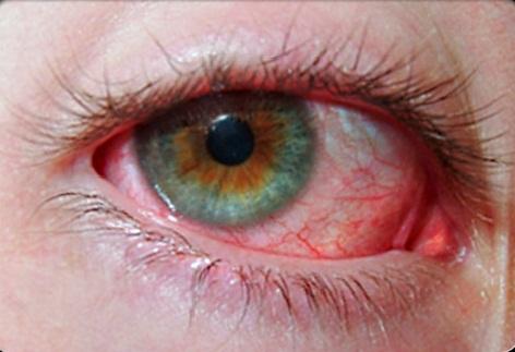 Eye flu or conjuctivitis